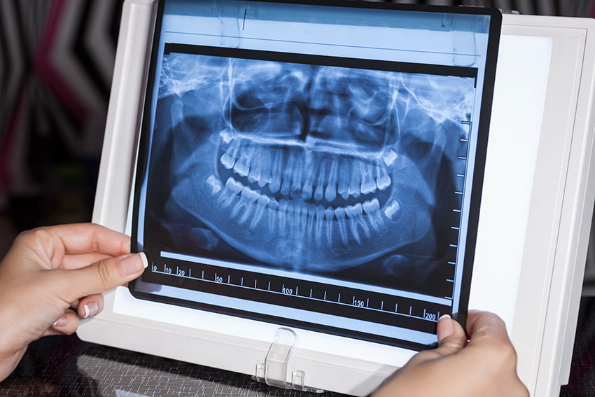 radiografias-dentales