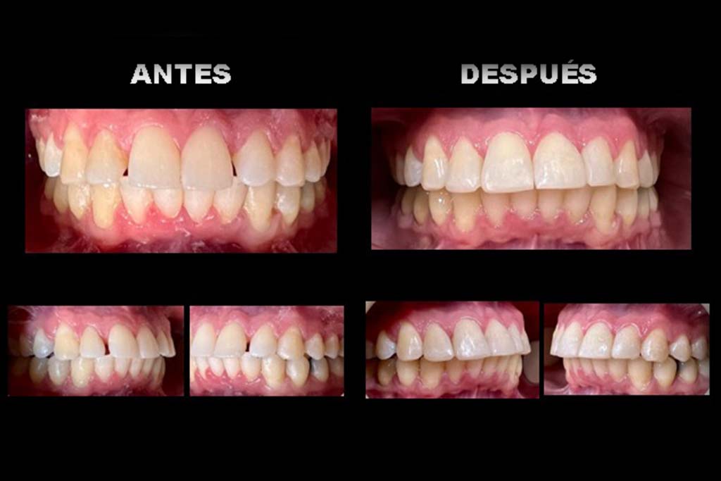 Tratamiento con resinas dentales